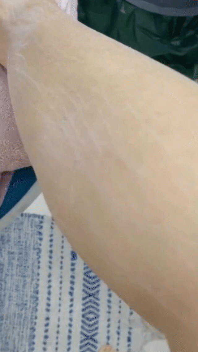 Exfoliation du tibia avec le gant exfoliant en soie Glowips™ montrant l’élimination des peaux mortes